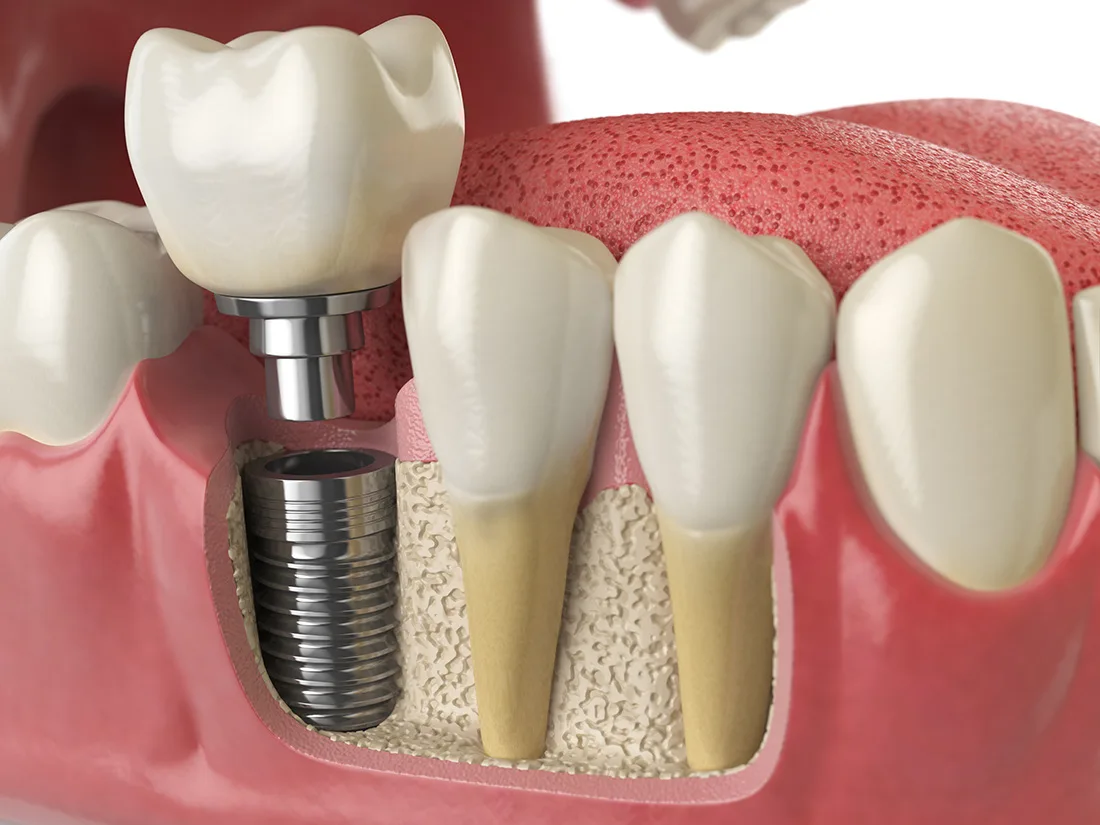 The Art of Patient-Centric Design in Dental Implants