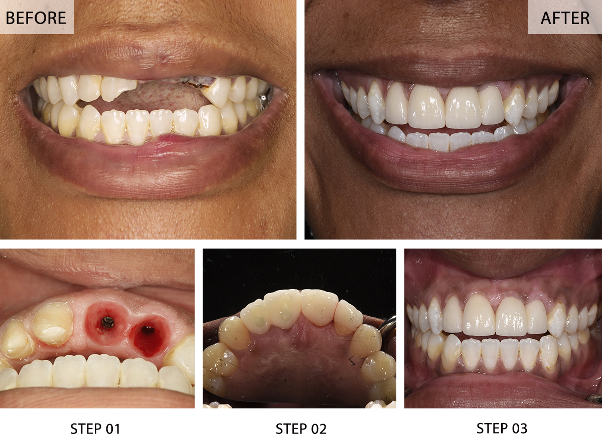 Unlocking Confidence: The Psychological Benefits of Dental Implants