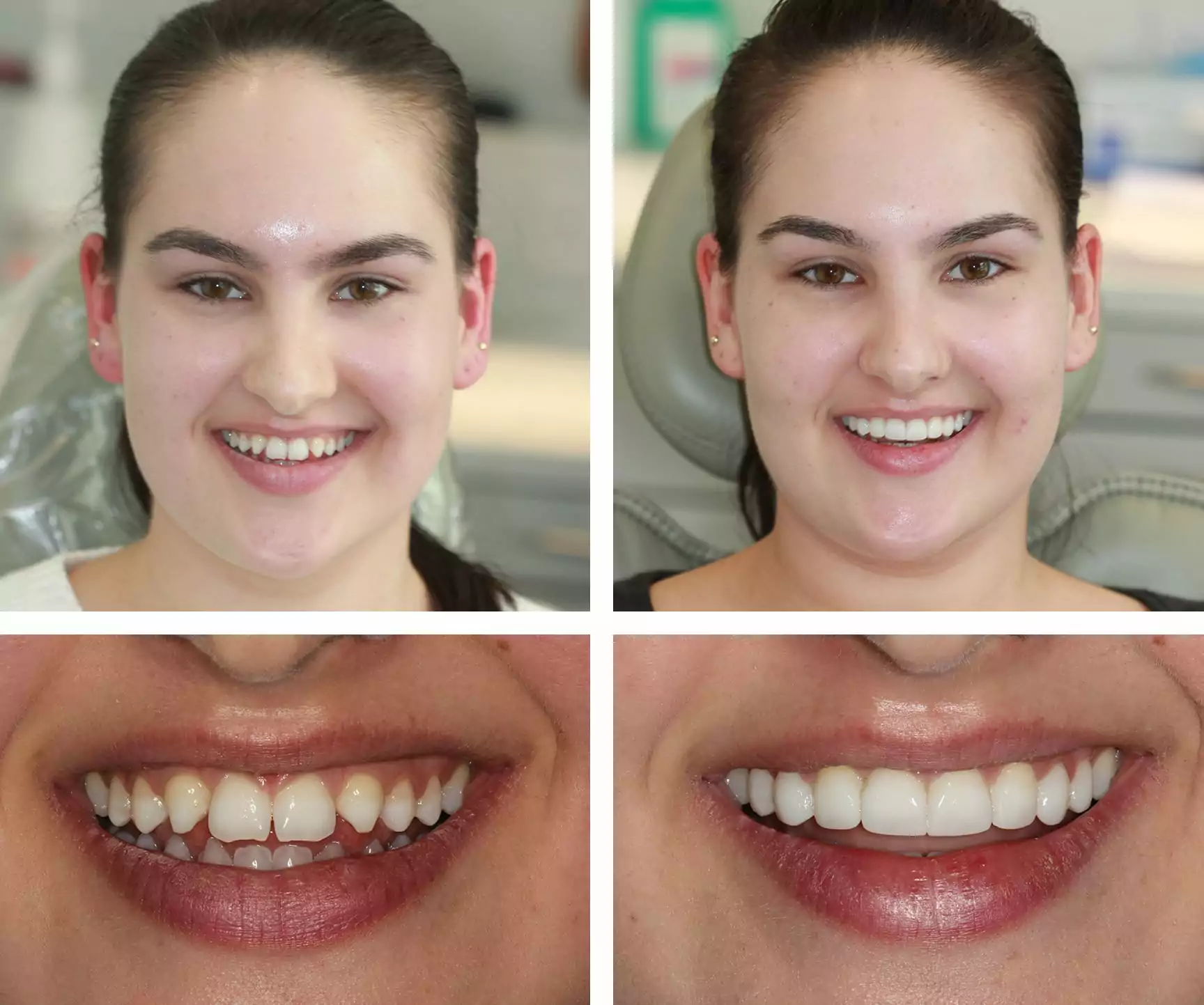 Composite Bonding: The Art of Mimicking Natural Teeth Texture