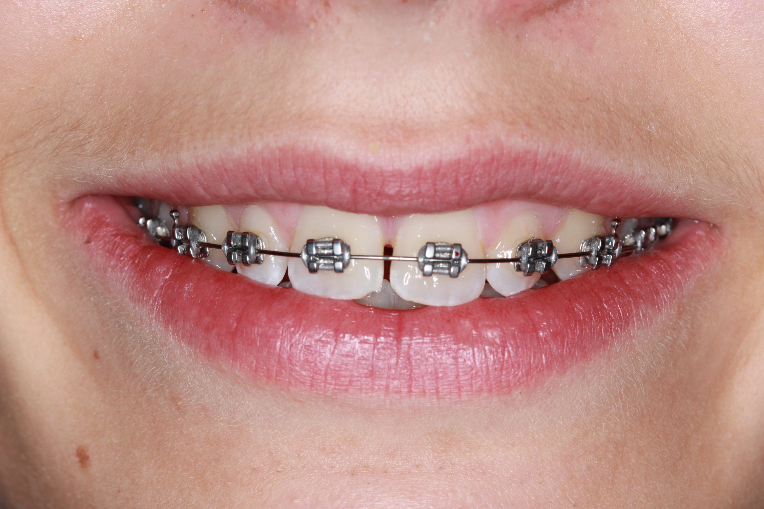 The Eco-Friendly Path: Sustainable Practices in Modern Braces